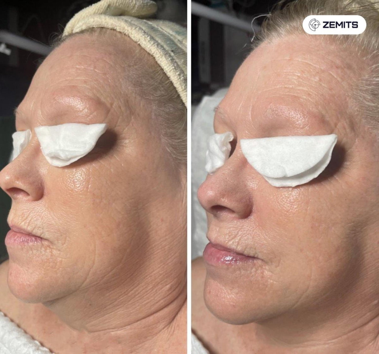 Zemits Klein EL Sistema de Electroporación