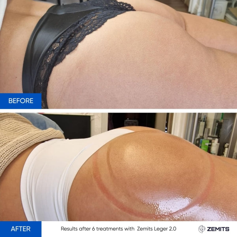 Zemits Leger 2.0 Sistema de Vacío con Copas XXL en Set